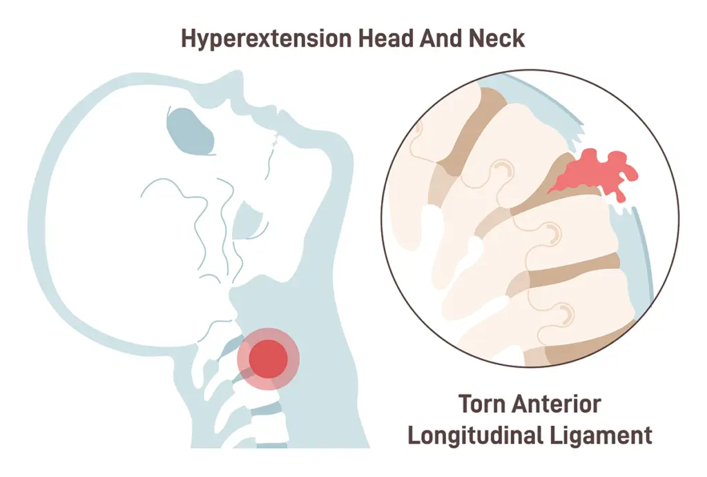 Ligament injury medical diagram
